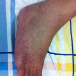 rash caused by chikungunya