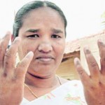 A woman whose entire village was infected with chikungunya. She exhibits severe joint inflammation.