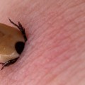 a tick biting through human flesh